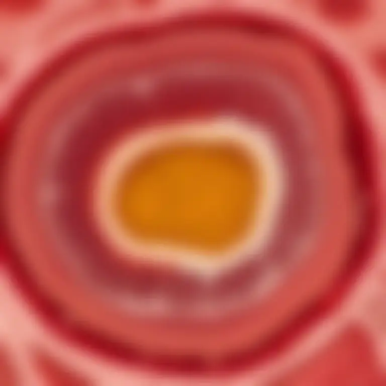 Visual representation of "plaque" - Abnormal accumulation of material in the inner layer of the wall of an artery.