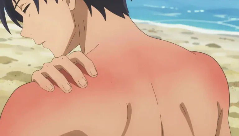 Visual representation of "sunburn" - A painful redness on the skin caused by too much exposure to the sun