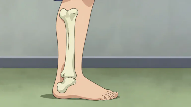 Visual representation of "malunion" - Malunion refers to a condition where a broken bone heals in an abnormal position, leading to functional impairment.