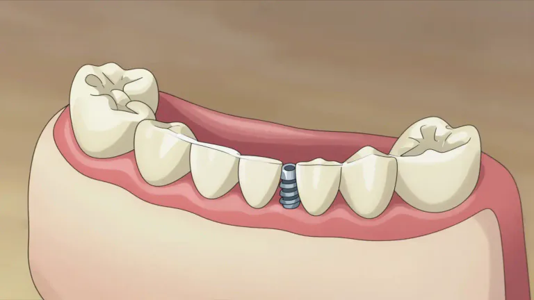 Visual representation of "subperiosteal" - Referring to the area beneath the periosteum of a bone.