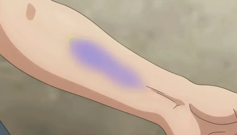 Visual representation of "ecchymosis" - Ecchymosis is the medical term for a discoloration of the skin resulting from bleeding underneath, typically due to bruising.